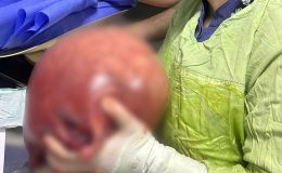 Trabzon’da karın ağrısı şikayetiyle gitti, 5.5 kg kitle çıktı